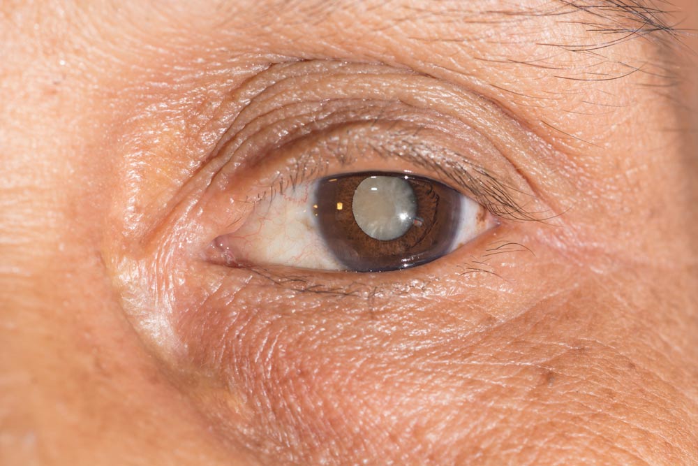 Cataract Warning Signs